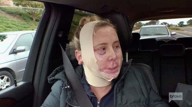 Shannon Beador FaceTight