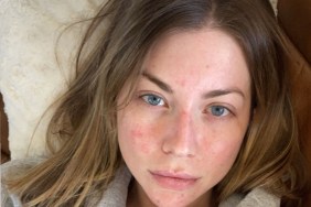 Stassi Schroeder Psoriasis